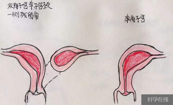 残角子宫