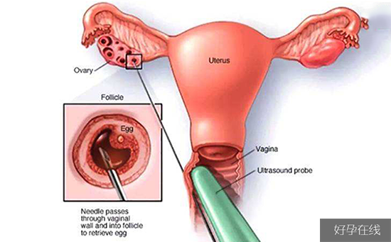 抽吸卵泡液