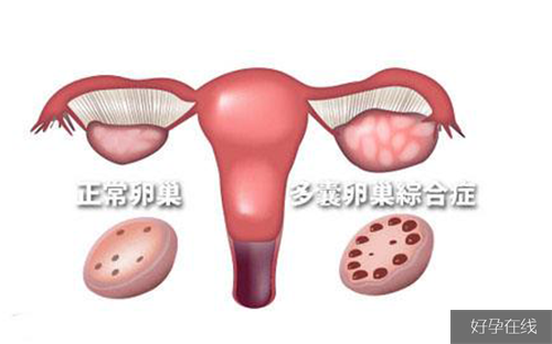 多囊卵巢综合征怀孕