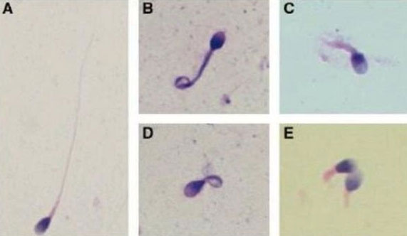 畸形精子的种类有很多种
