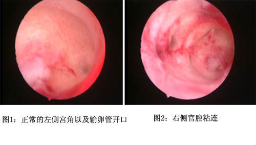 宫腔粘连检查报告