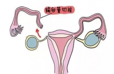 河北慈铭博鳌国际医院三代试管婴儿，切除双侧输卵管还能做试管婴儿吗？